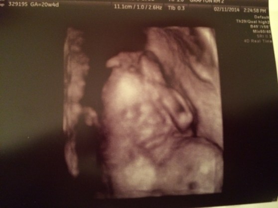 3D Ultrasound Face Pic! This one is my second fave. Smooshy pout face.